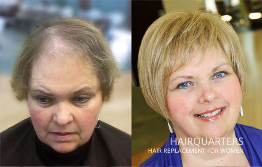 Women's Hair Replacement | Surfside Beach SC