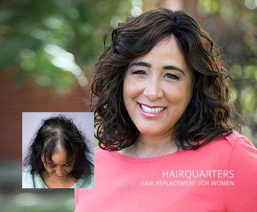 womens hair loss replacement myrtle beach sc