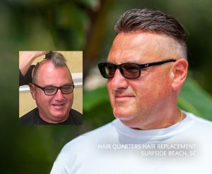 hair restoration clinic myrtle beach sc