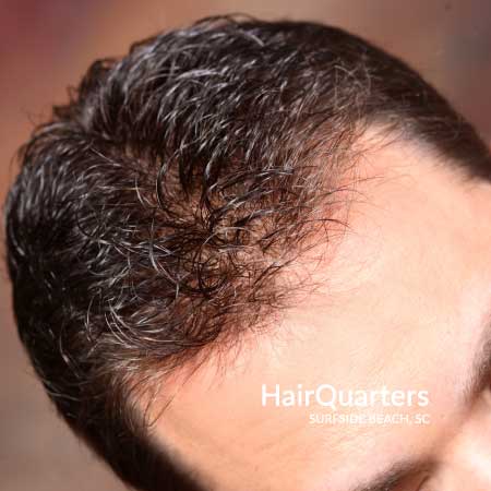 hair loss treatment myrtle beach sc